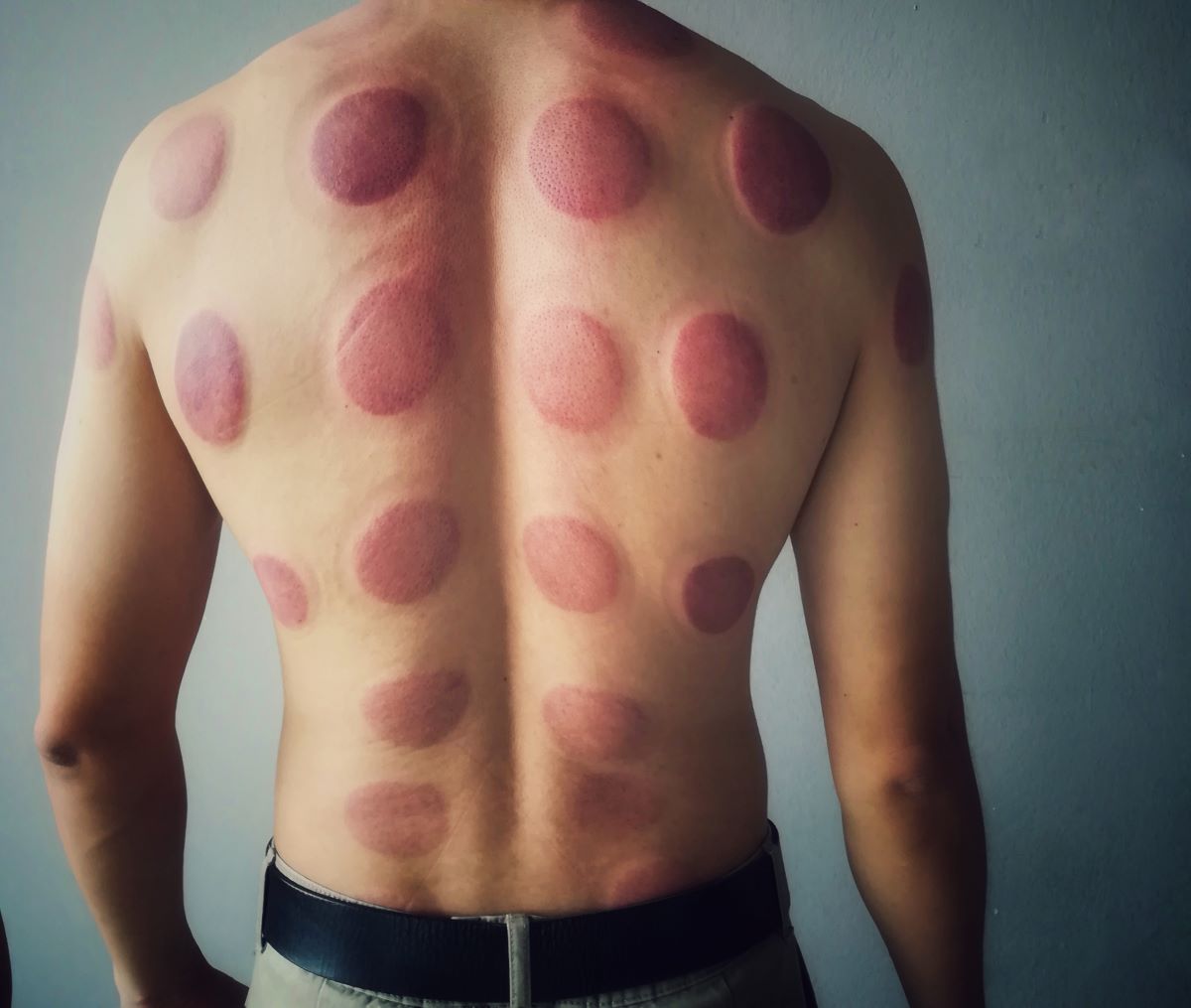cupping therapy traces